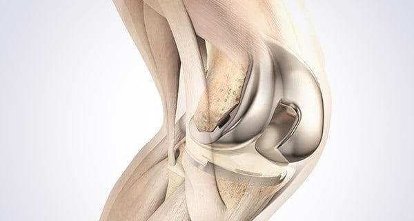 پوشش نانوذرات نقره خطر رد اینپلنت های بافت استخوانی را کاهش می دهد